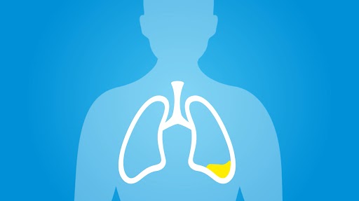 pneumococcal pneumonia